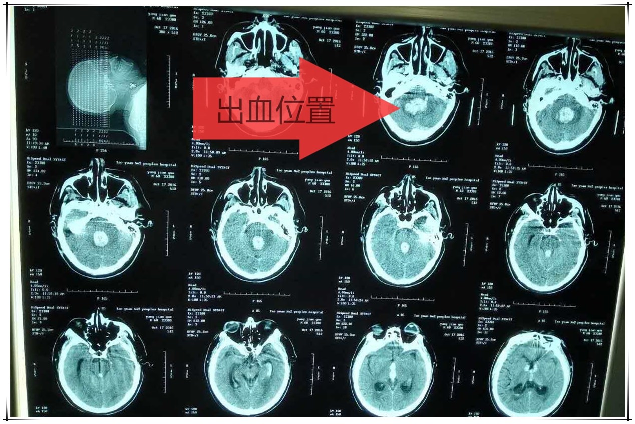 燕某術前CT_看圖王.jpg